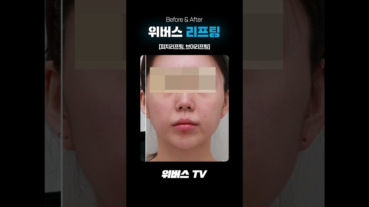 Виверс гоо сайхны мэс заслын эмнэлэг Пийч+В лифтинг🧡