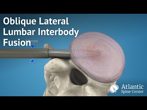 Oblique Lateral Lumbar Interbody Fusion Overview