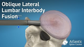 Oblique Lateral Lumbar Interbody Fusion