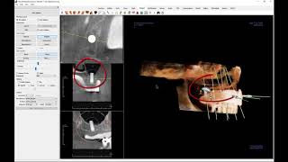 Invivo 6™ Tutorial - Implant View Tab - Bone Graft Simulation