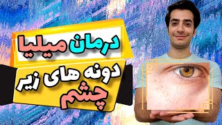 درمان میلیا | جوش های ریز دور چشم