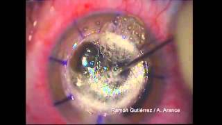 NOVOVISION - Técnicas de trasplante de cornea IV