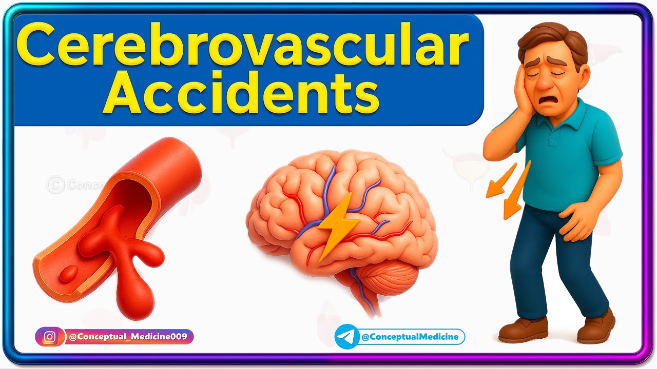 19. Cerebrovascular Accidents 🧠💥 | Stroke Types, Signs, and Golden Hour ...