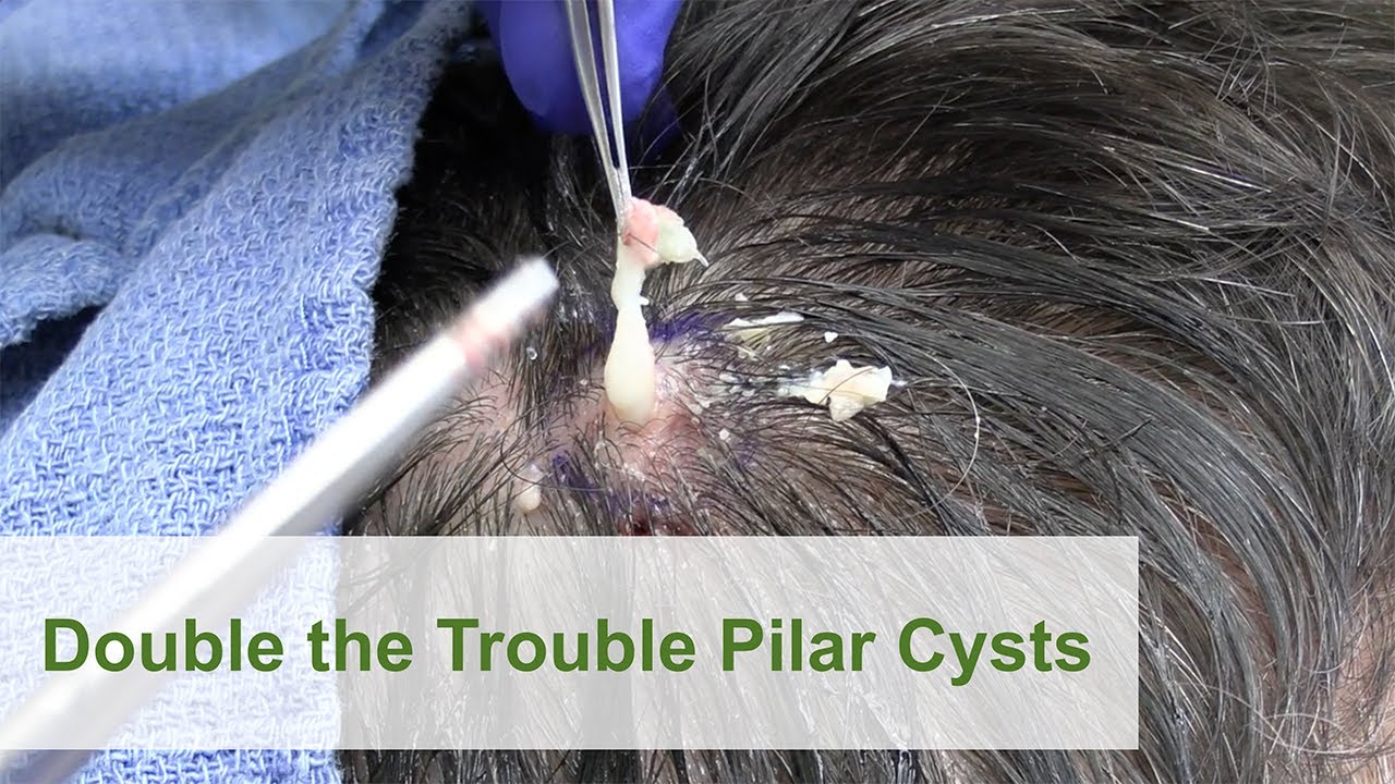 Double The Trouble Pilar Cysts Dr Derm Youtube