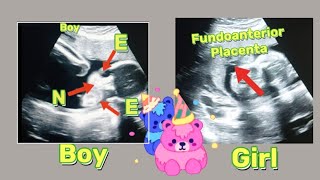 22 wk Fetal heartbeat anomaly ultrasound |  Fundal Anterior placenta means baby boy/girl | pregnancy