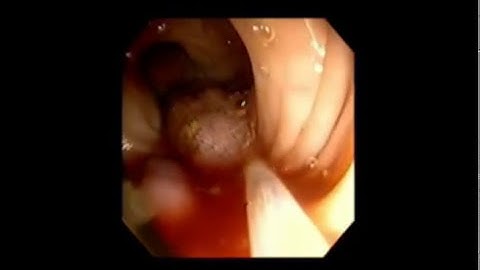 ROTH NET™ Retriever - Multiple Polyp Retrieval