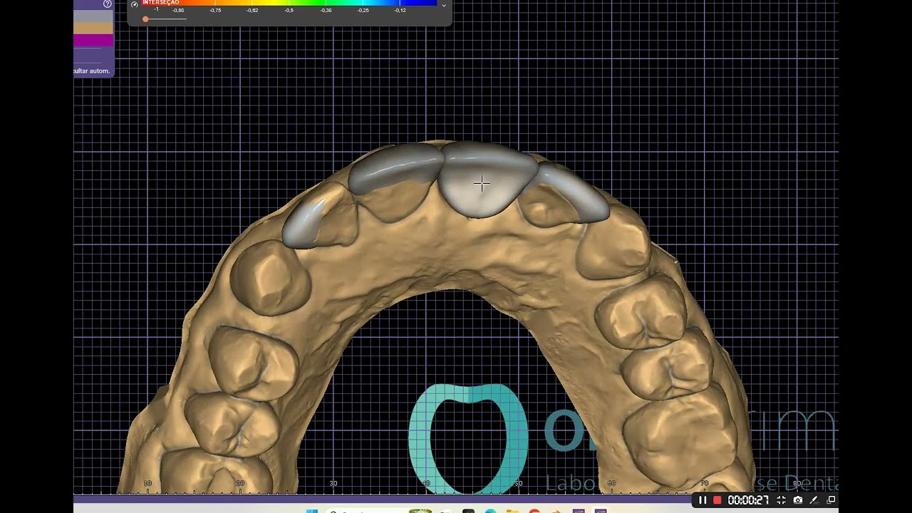 Escaneamento intraoral 3D no consultório