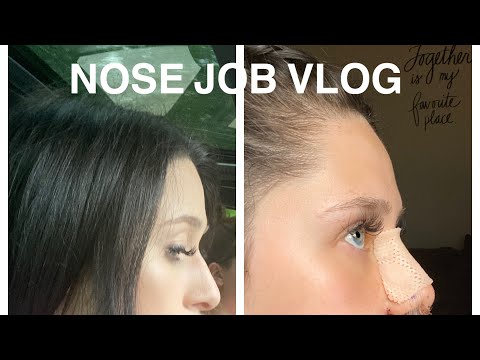 nose-job-vlog!-price,-recovery,-what-to-expect,-before-&-after!