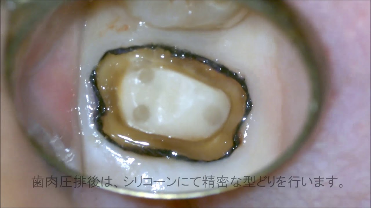 圧排 歯肉 精密な歯の型採りのために 歯肉の二重圧排とは？