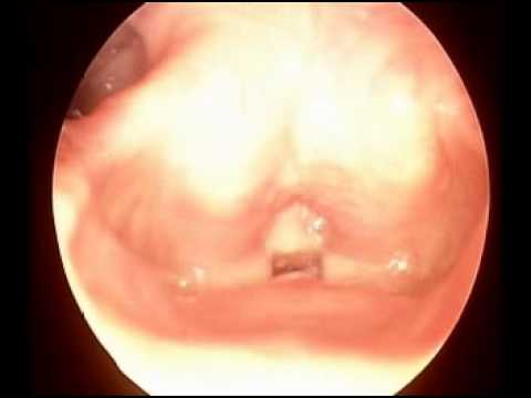 granuloma en los pulmones cura la diabetes granuloma en los pulmones cura la diabetes