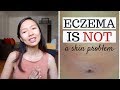 what causes eczema