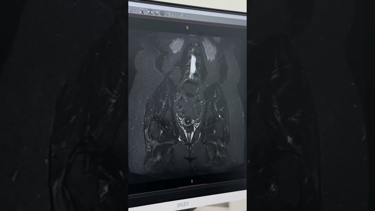 Боль в левой ноге. Путь пациента от травматолога-ортопеда до нейрохирурга