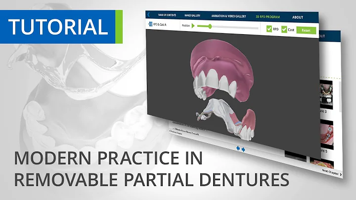 Mastering Removable Partial Dentures: The Ultimate Guide