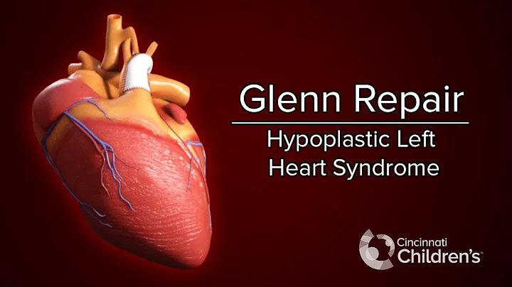 Medical Animation: Glenn Operation | Cincinnati Children's