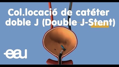 Col.locació de catéter doble J