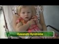 Kawasaki Disease