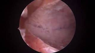 Histereskopik Septum İnsizyonu - Dr. Turgut Aydın