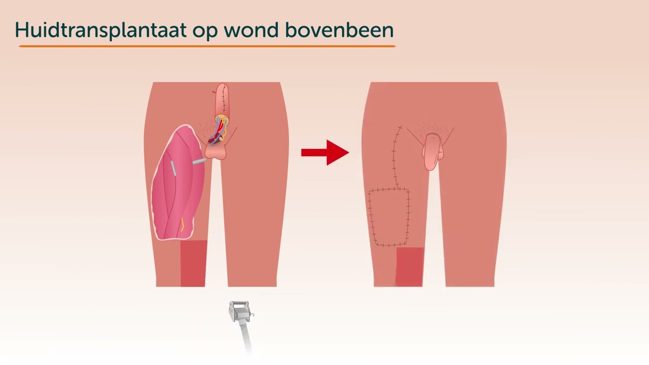 Genitale chirurgie (vermannelijking): phalloplastiek