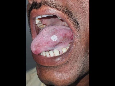 Video: Leukoplakie - Symptome, Behandlung, Einfache Und Haarige Leukoplakie