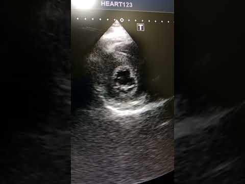 Severe Concentric LVH HCM 