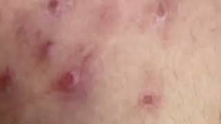 new pimple popping videos blackheads 2023 5