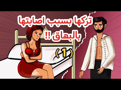 قصص واقعية تركها بسبب اصابتها بالبـ ـهاق