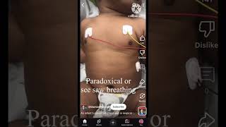 Breathing difficulty in a baby