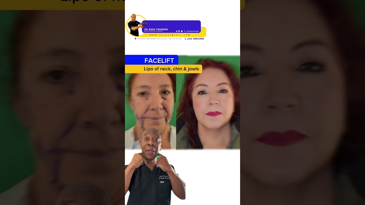 Facelift with Lipo of neck, chin and jowls