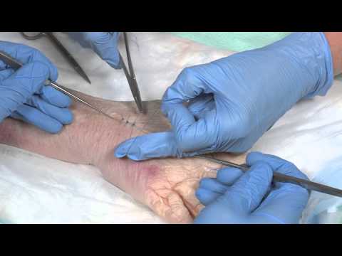 Comment suture - Partie 2: sutures simples et sutures de matelas