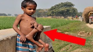 10 Most Bizarre Twin Types
