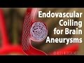 Endovascular Coiling for Brain Aneurysm, Animation.