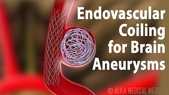 Endovascular Coiling for Brain Aneurysm, Animation.