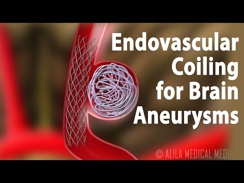 Endovascular Coiling for Brain Aneurysm, Animation