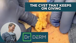 The Cyst that Keeps on Giving | Dr. Derm