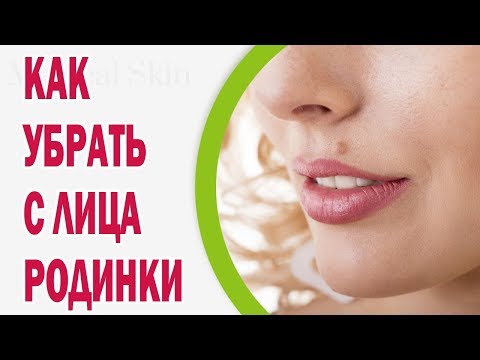 Удаление папиллом йодом отзывы