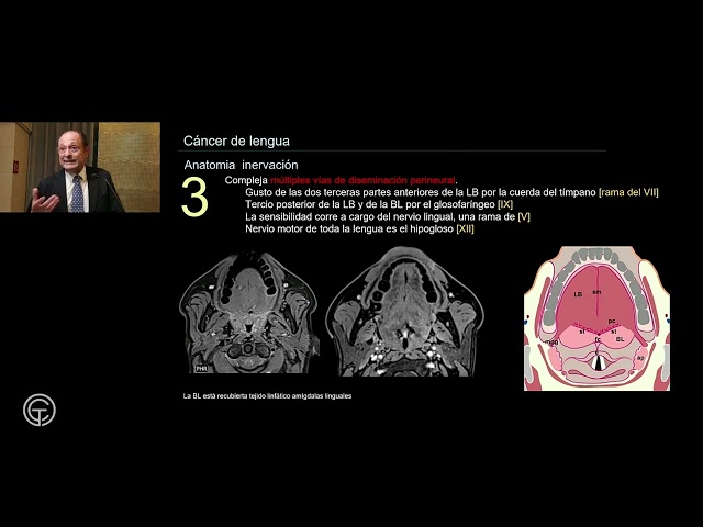 Patología Orofaríngea estadiaje del cáncer de lengua