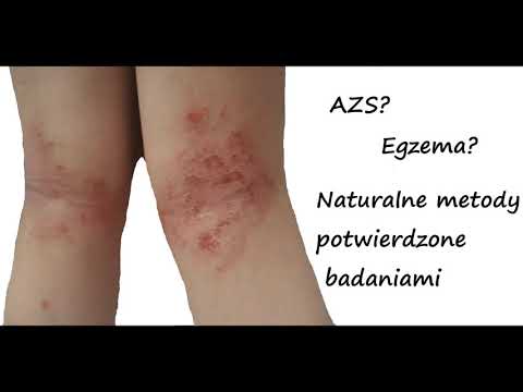 Wideo: 4 sposoby na naturalne leczenie egzemy u niemowląt