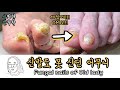 (Eng)열발가락 모두 두꺼워진 무좀발톱 스케일링! Serious case of fungal toenail [NP케어]