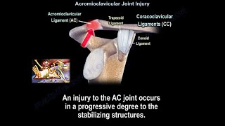 Acromioclavicular Joint Injury, AC separation  - Everything You Need To Know - Dr. Nabil Ebraheim