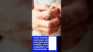Is leech therapy in Ayurveda?/ What are the benefits of leech therapy?#shorts