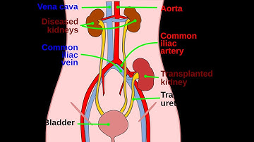 Kidney Transplantation CPT codes - simplify medical coding