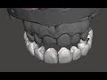 Digitally Creating Snap on Teeth that can be 3d Printed