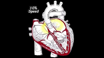 Unifocal Atrial Tachycardia animation