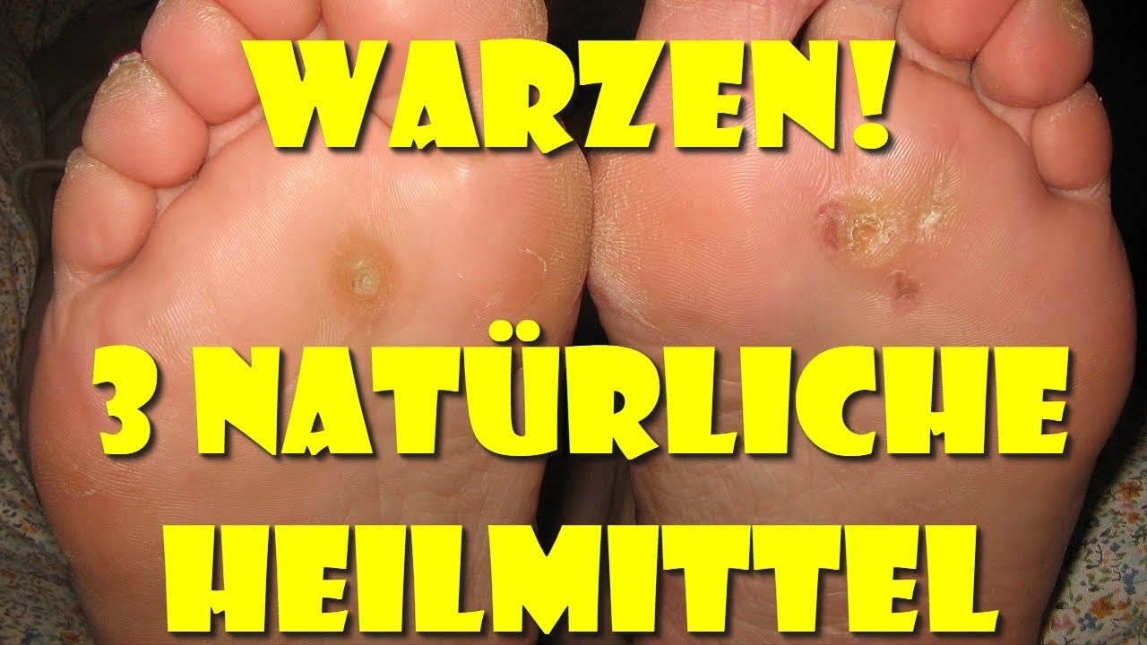 Warzen sind unansehnlich - Wie Du Warzen auf natürliche Weise loswirst