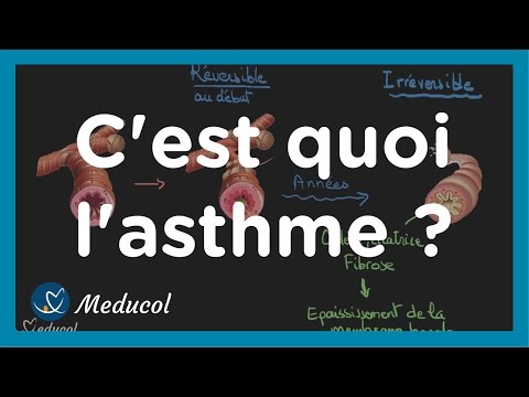 Vidéo: Asthme Intermittent: Qu'est-ce Que C'est Et Comment Le Traiter?