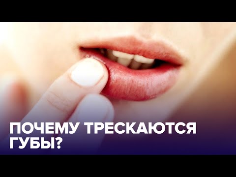 Почему ТРЕСКАЮТСЯ губы? Причины и что с этим делать