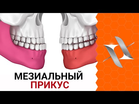 МЕЗИАЛЬНЫЙ прикус | Причины. Последствия. Лечение.