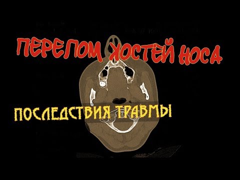 ПЕРЕЛОМ КОСТЕЙ НОСА со смещением на РАСШИФРОВКЕ КТ носа  Последствия перелома костей носа