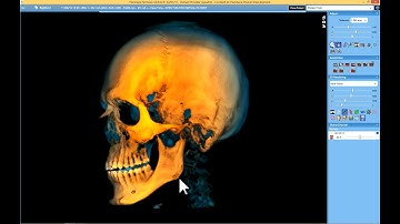 New Enhanced Depth View for 3D Rendering in Planmeca Romexis 4.0