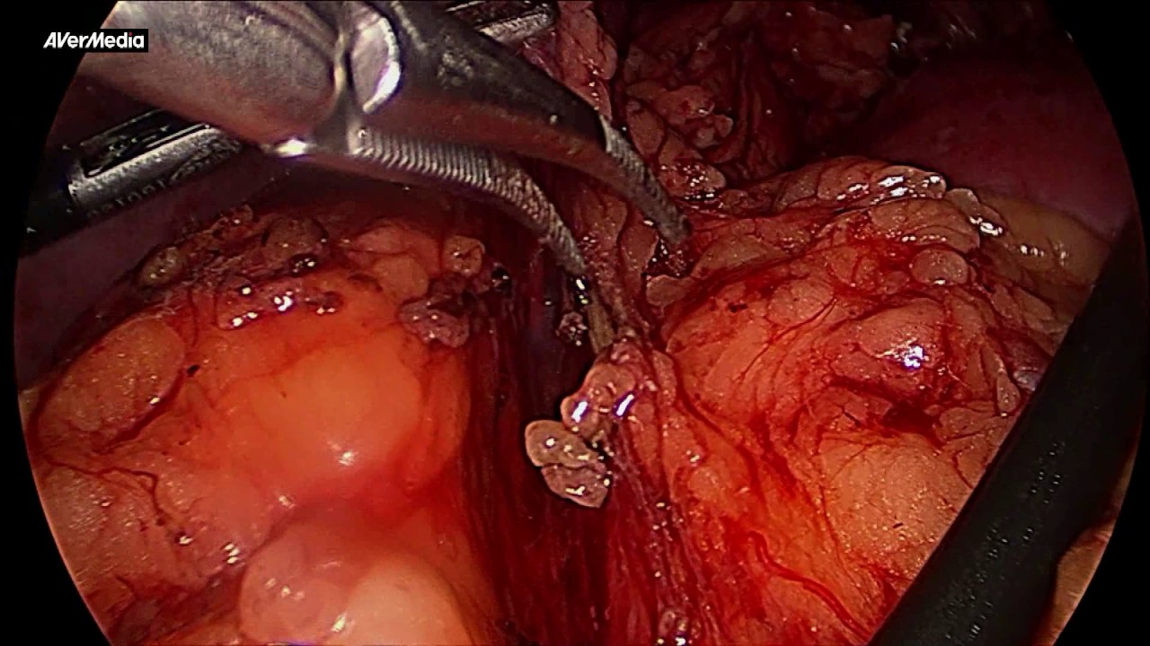 Удаление надпочечника. Лапароскопическая адреналэктомия слева. Laparoscopic left adrenalectomy